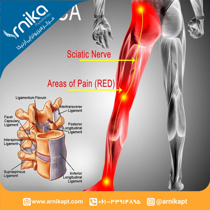 فیزیوتراپی عصب سیاتیک