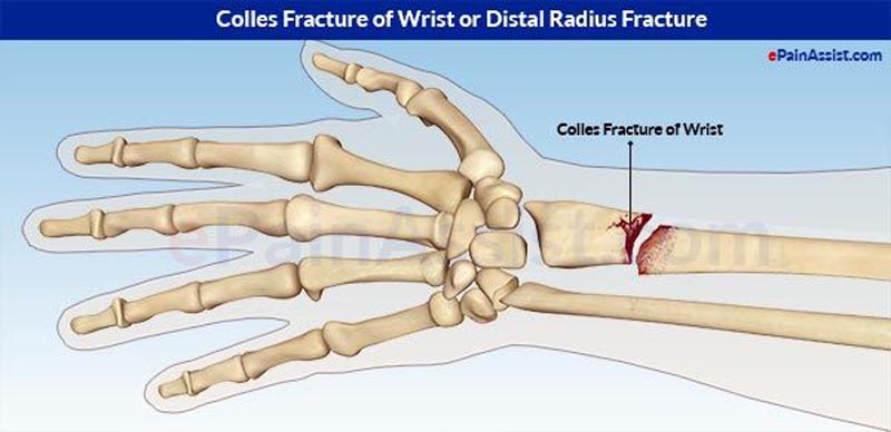 شکستگی مچ دست