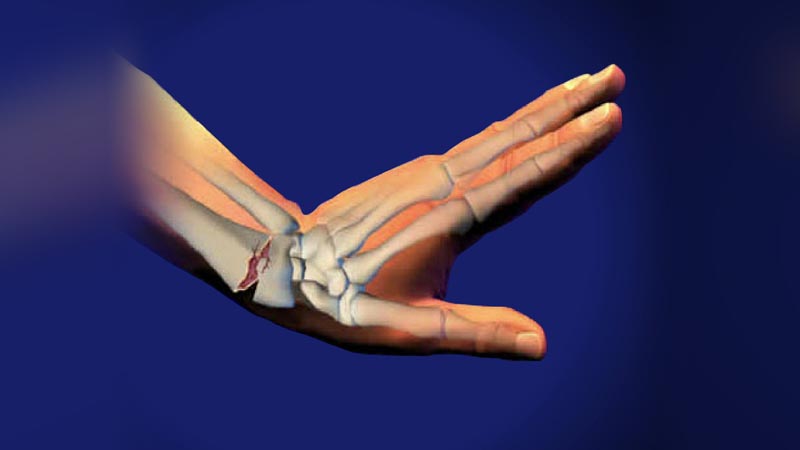 شکستگی کالیس