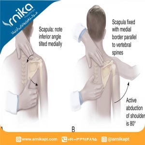 اختلال عملکرد کتف