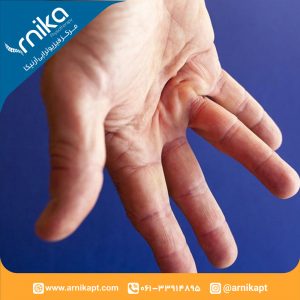 انقباض دوپویترن