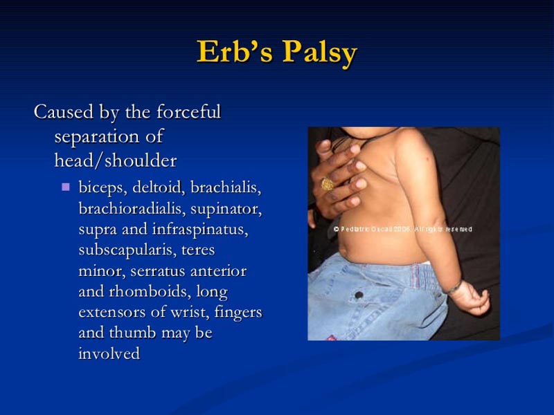 فیزیوتراپی فلج ارب