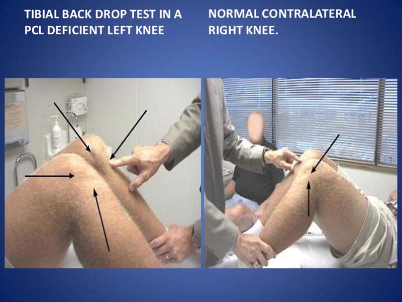 فیزیوتراپی اختلالات داخلی زانو