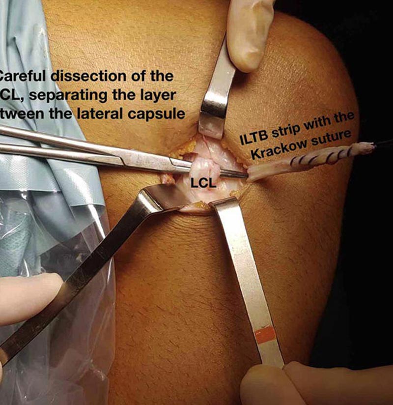 رباط جانبی خارجی زانو