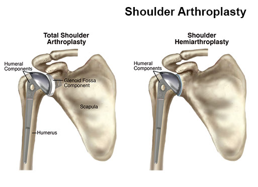 فیزیوتراپی آرتروپلاستی